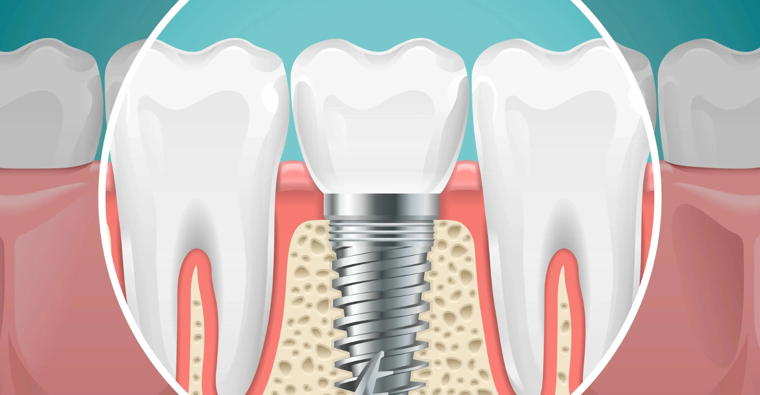 Dental Implants in Turkey Cost Inblog
